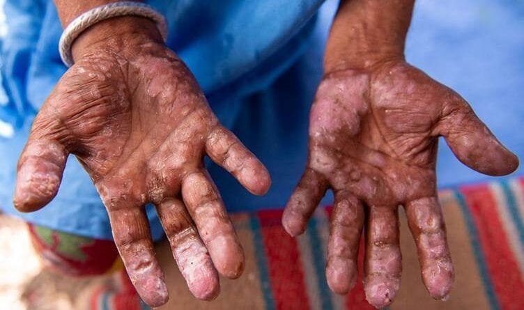 Li Ewropayê alarm, kotîbûn piştî 44 salan vegeriya