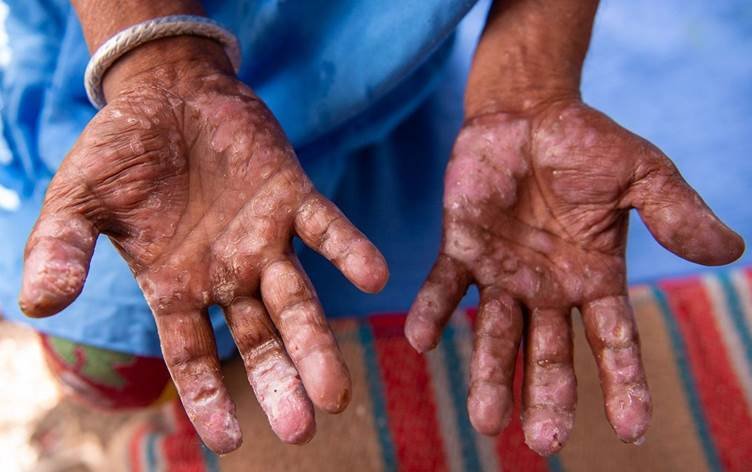 Li Ewropayê alarm, kotîbûn piştî 44 salan vegeriya